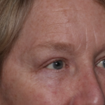 Upper Blepharoplasty Before & After Patient #35771