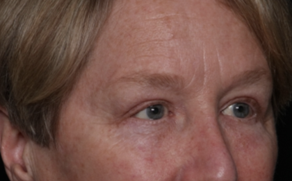 Upper Blepharoplasty Before & After Patient #35771