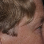 Upper Blepharoplasty Before & After Patient #35771