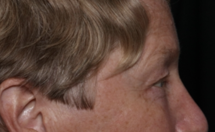 Upper Blepharoplasty Before & After Patient #35771