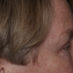 Upper Blepharoplasty Before & After Patient #35771
