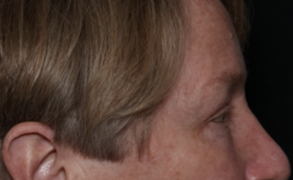 Upper Blepharoplasty Before & After Patient #35771