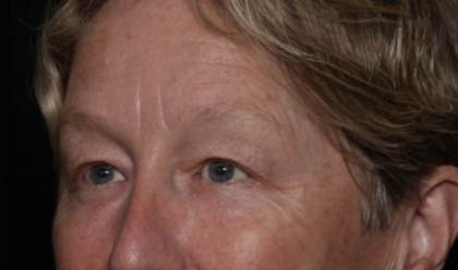 Upper Blepharoplasty Before & After Patient #35771