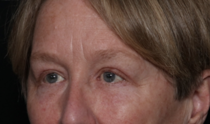 Upper Blepharoplasty Before & After Patient #35771