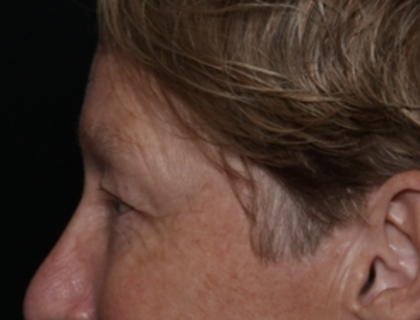 Upper Blepharoplasty Before & After Patient #35771