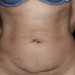 Tummy Tuck Before & After Patient #35999