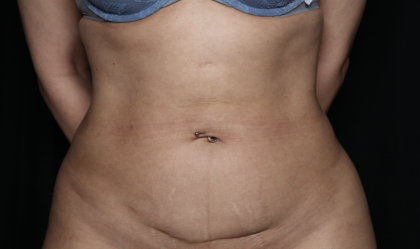 Tummy Tuck Before & After Patient #35999