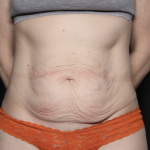 Tummy Tuck Before & After Patient #35933
