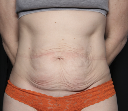 Tummy Tuck Before & After Patient #35933