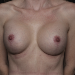 Breast Implant Exchange Before & After Patient #36010
