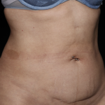 Tummy Tuck Before & After Patient #35999