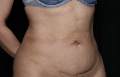 Tummy Tuck Before & After Patient #35999