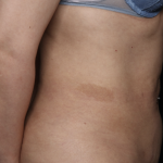 Tummy Tuck Before & After Patient #35999