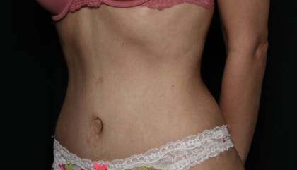 Tummy Tuck Before & After Patient #35999