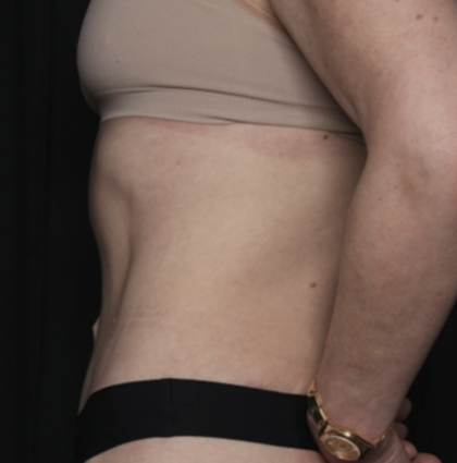 Tummy Tuck Before & After Patient #35933