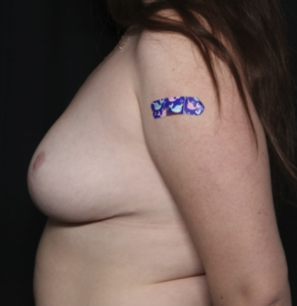 Breast Reduction Before & After Patient #35944
