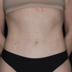 Tummy Tuck Before & After Patient #35933
