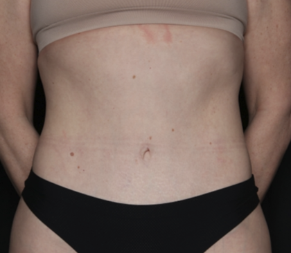 Tummy Tuck Before & After Patient #35933
