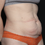 Tummy Tuck Before & After Patient #35933