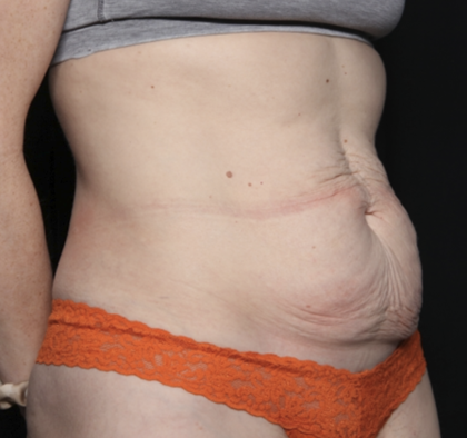 Tummy Tuck Before & After Patient #35933