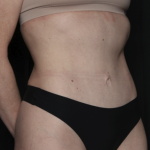 Tummy Tuck Before & After Patient #35933