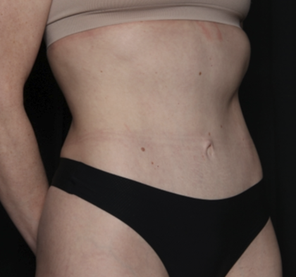 Tummy Tuck Before & After Patient #35933