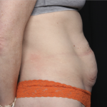 Tummy Tuck Before & After Patient #35933