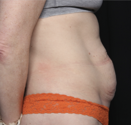 Tummy Tuck Before & After Patient #35933