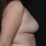 Breast Reduction Before & After Patient #35944