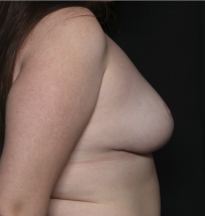 Breast Reduction Before & After Patient #35944