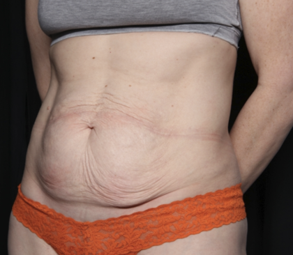 Tummy Tuck Before & After Patient #35933