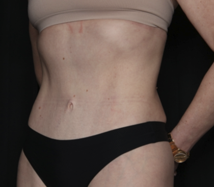 Tummy Tuck Before & After Patient #35933