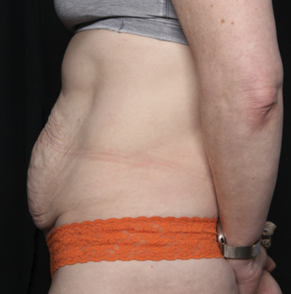 Tummy Tuck Before & After Patient #35933