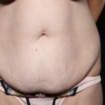 Tummy Tuck Before & After Patient #35906