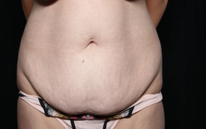 Tummy Tuck Before & After Patient #35906