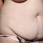 Tummy Tuck Before & After Patient #35906