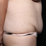 Tummy Tuck Before & After Patient #35906
