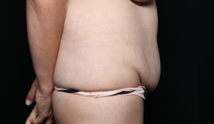 Tummy Tuck Before & After Patient #35906