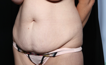 Tummy Tuck Before & After Patient #35906