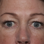 Upper Blepharoplasty Before & After Patient #36036