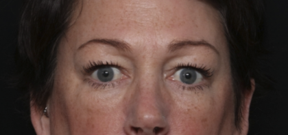 Upper Blepharoplasty Before & After Patient #36036
