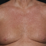 Gynecomastia Before & After Patient #36025