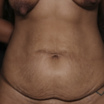 Tummy Tuck Before & After Patient #36047