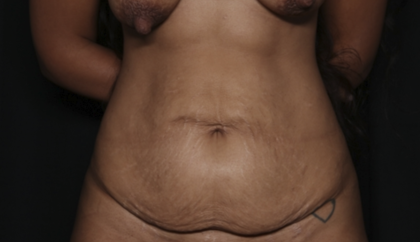 Tummy Tuck Before & After Patient #36047