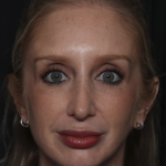 Injectable Fillers Before & After Patient #36124