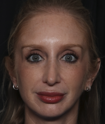 Injectable Fillers Before & After Patient #36124
