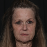 Injectable Fillers Before & After Patient #36148
