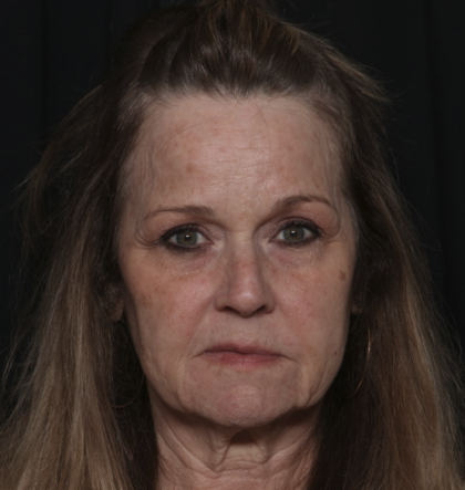 Injectable Fillers Before & After Patient #36148