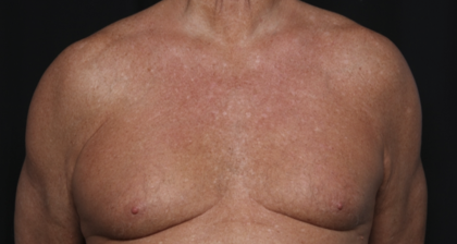 Gynecomastia Before & After Patient #36025