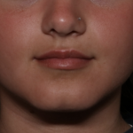Injectable Fillers Before & After Patient #36166